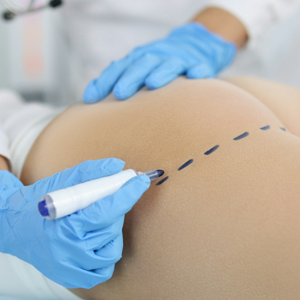 non surgical bbl treatment image 3