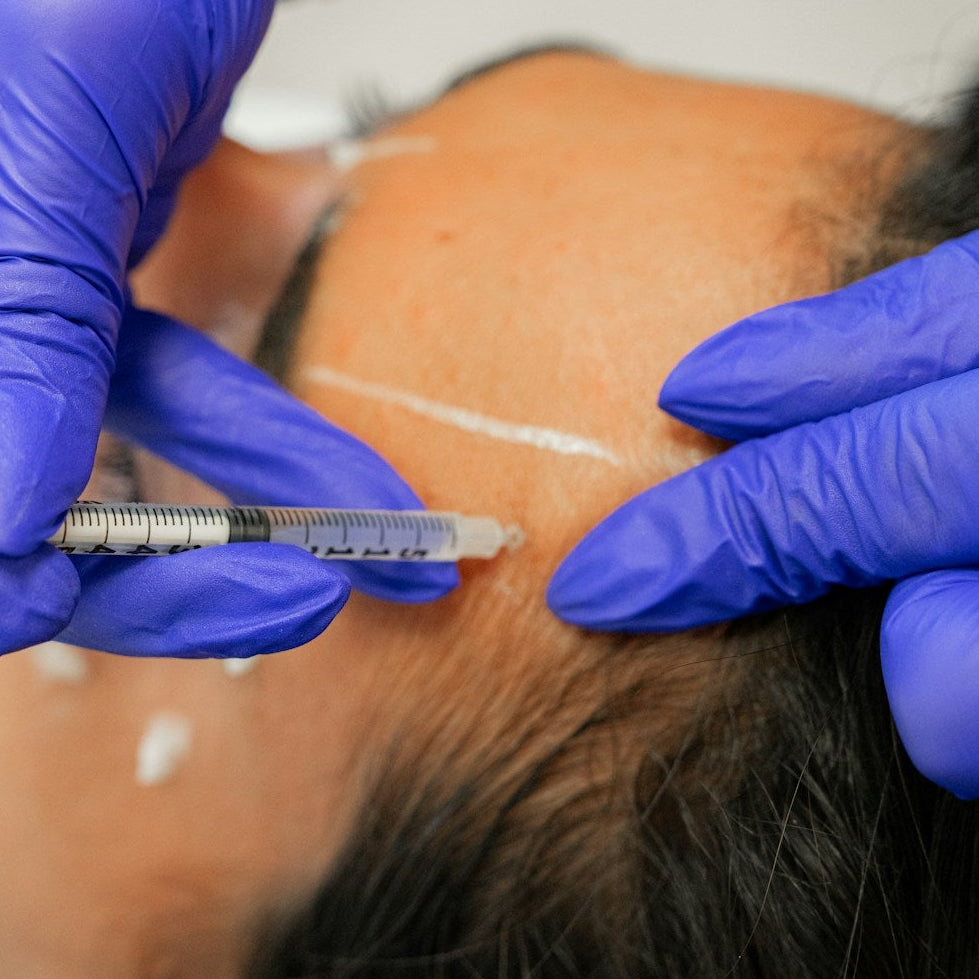 Non Surgical Faceliftt Treatment Image 2