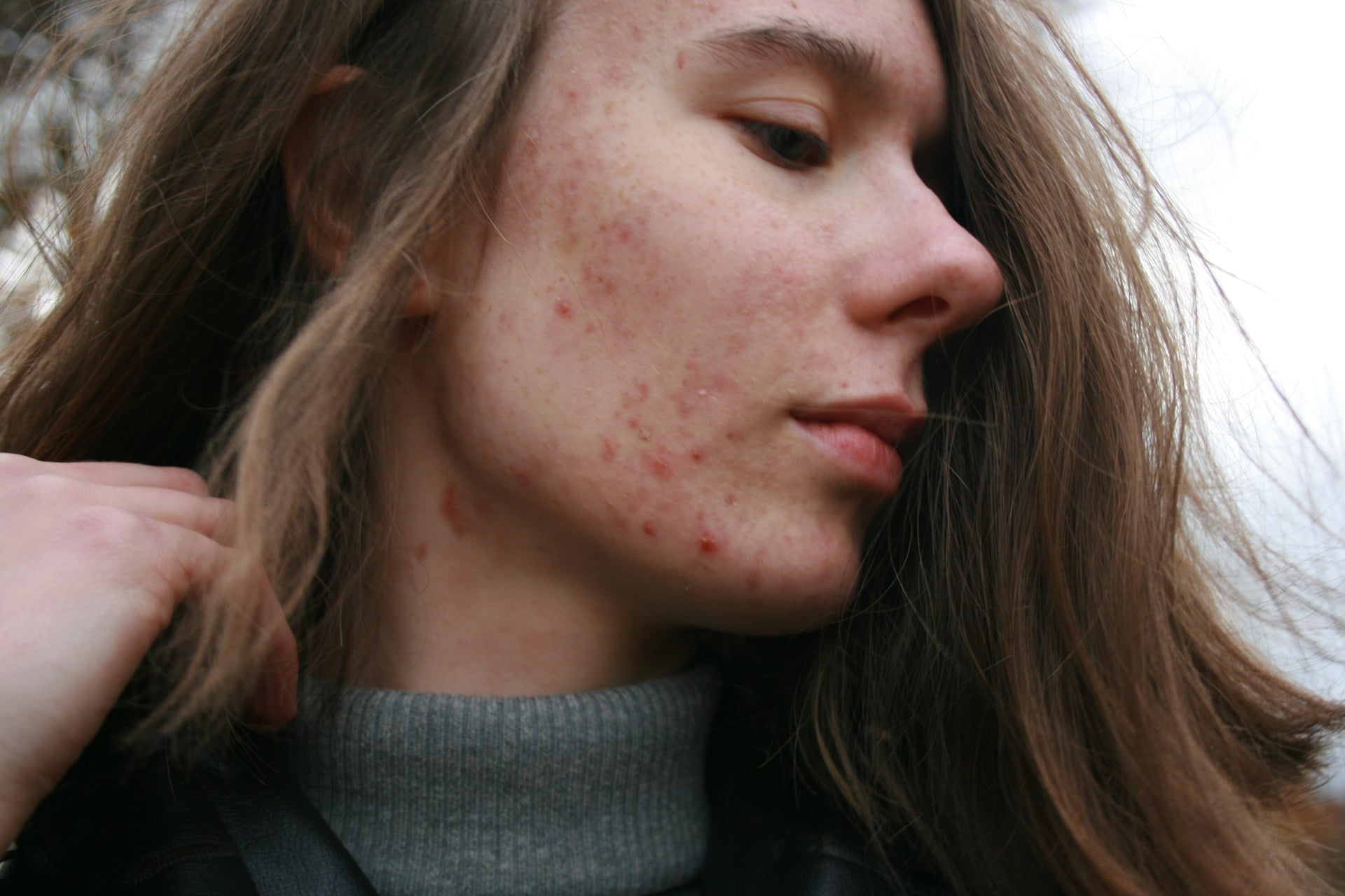Rosacea Redness Concern