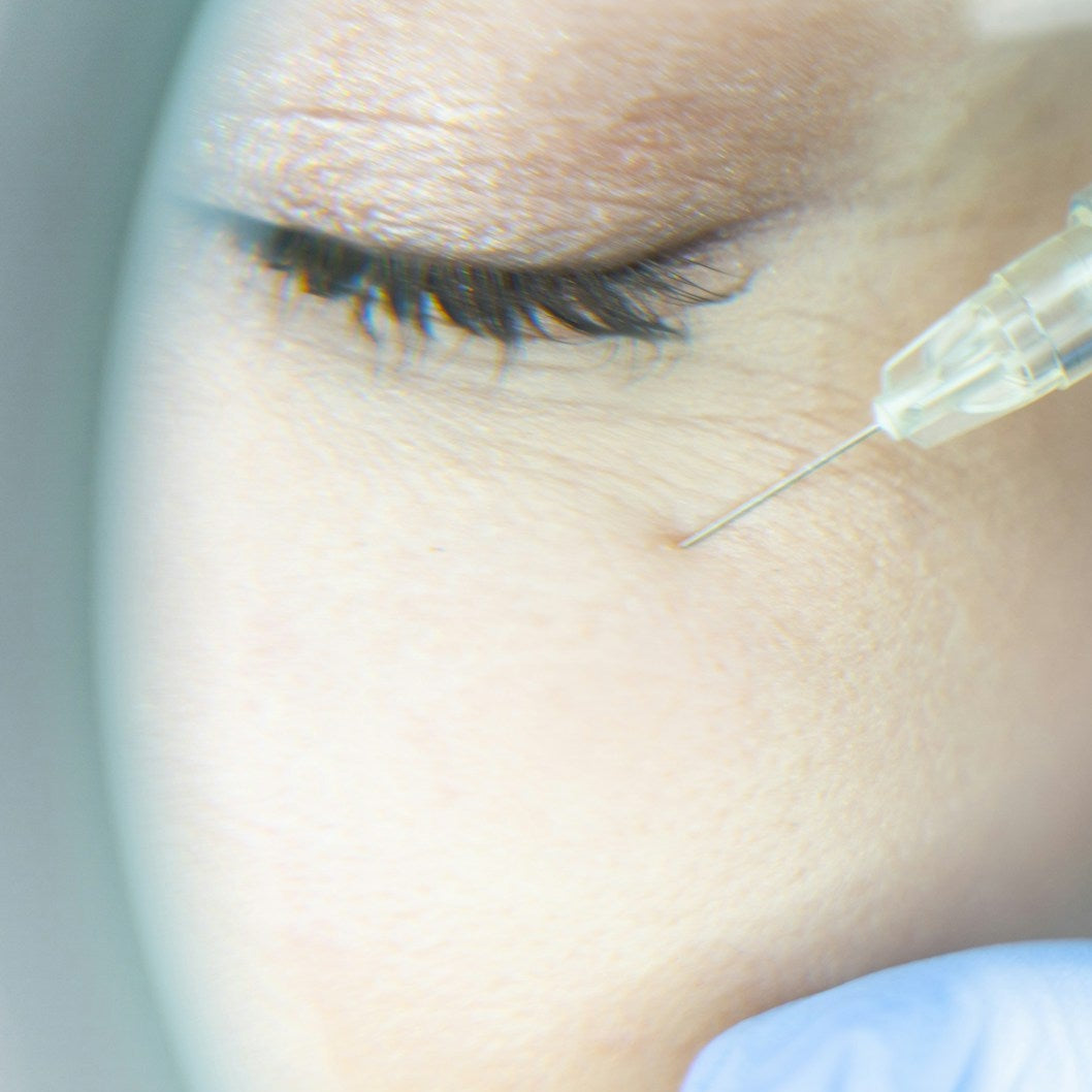 Tear Trough Filler Under Eye Filler Treatment Image 1