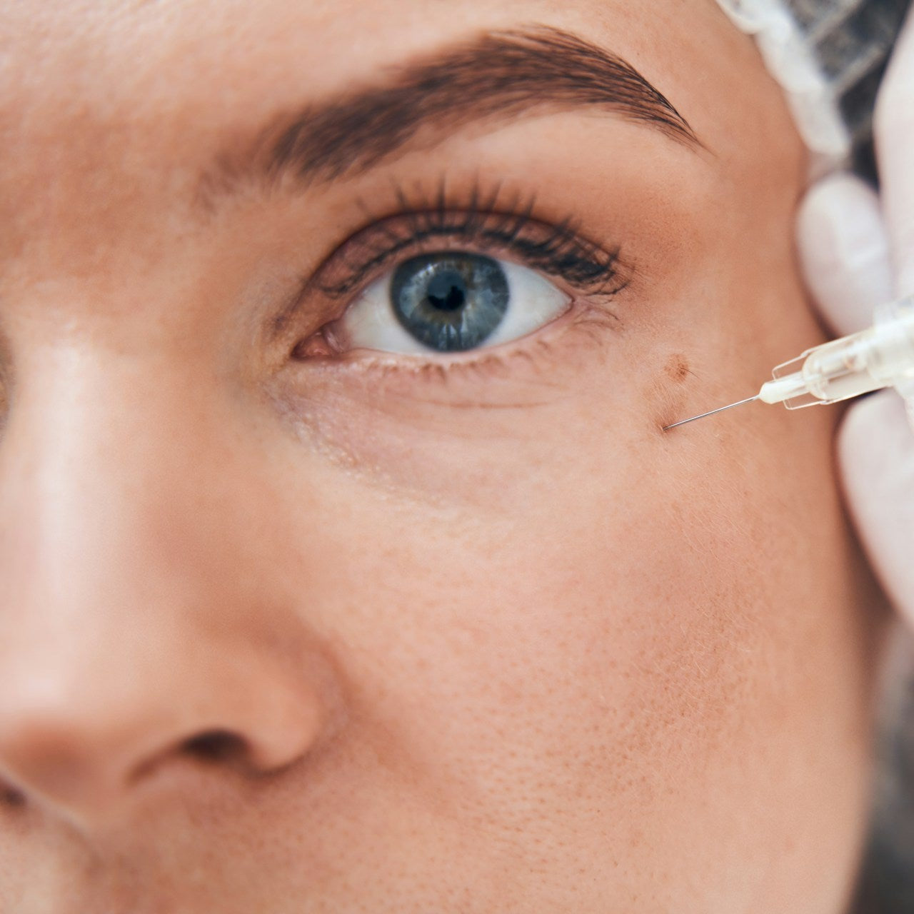 Tear Trough Filler Under Eye Filler Treatment Image 2
