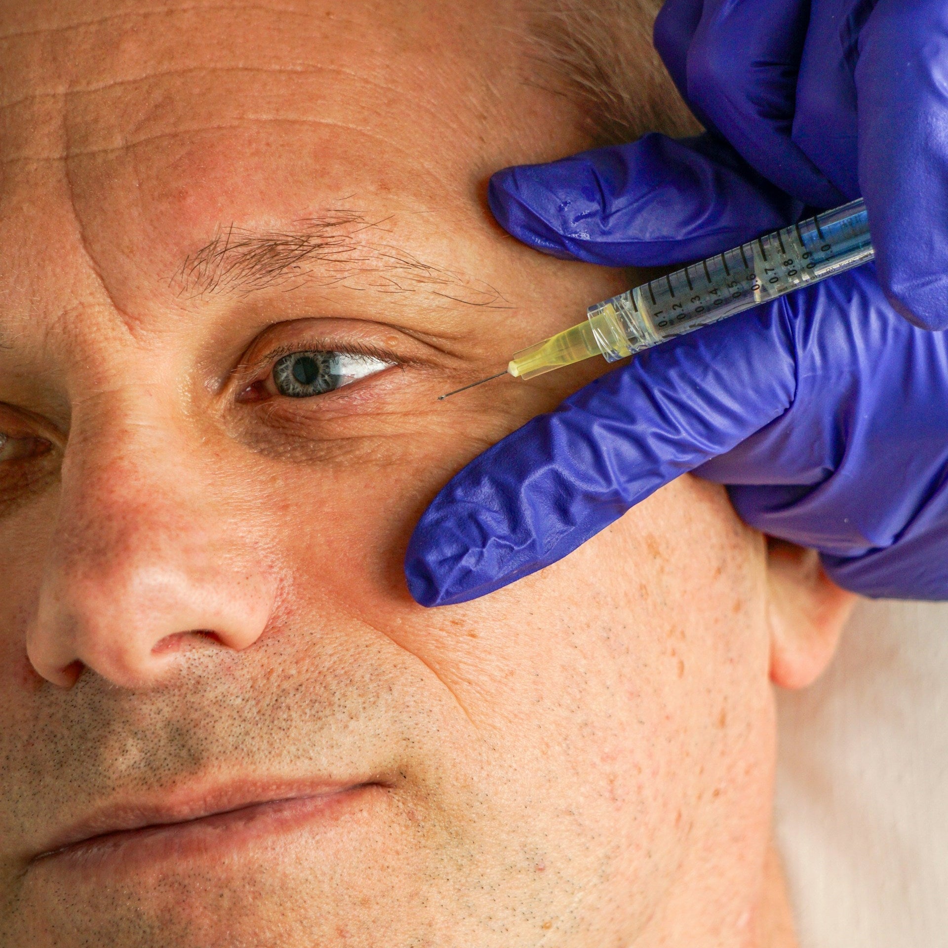 Tear Trough Filler Under Eye Filler Treatment Image 3