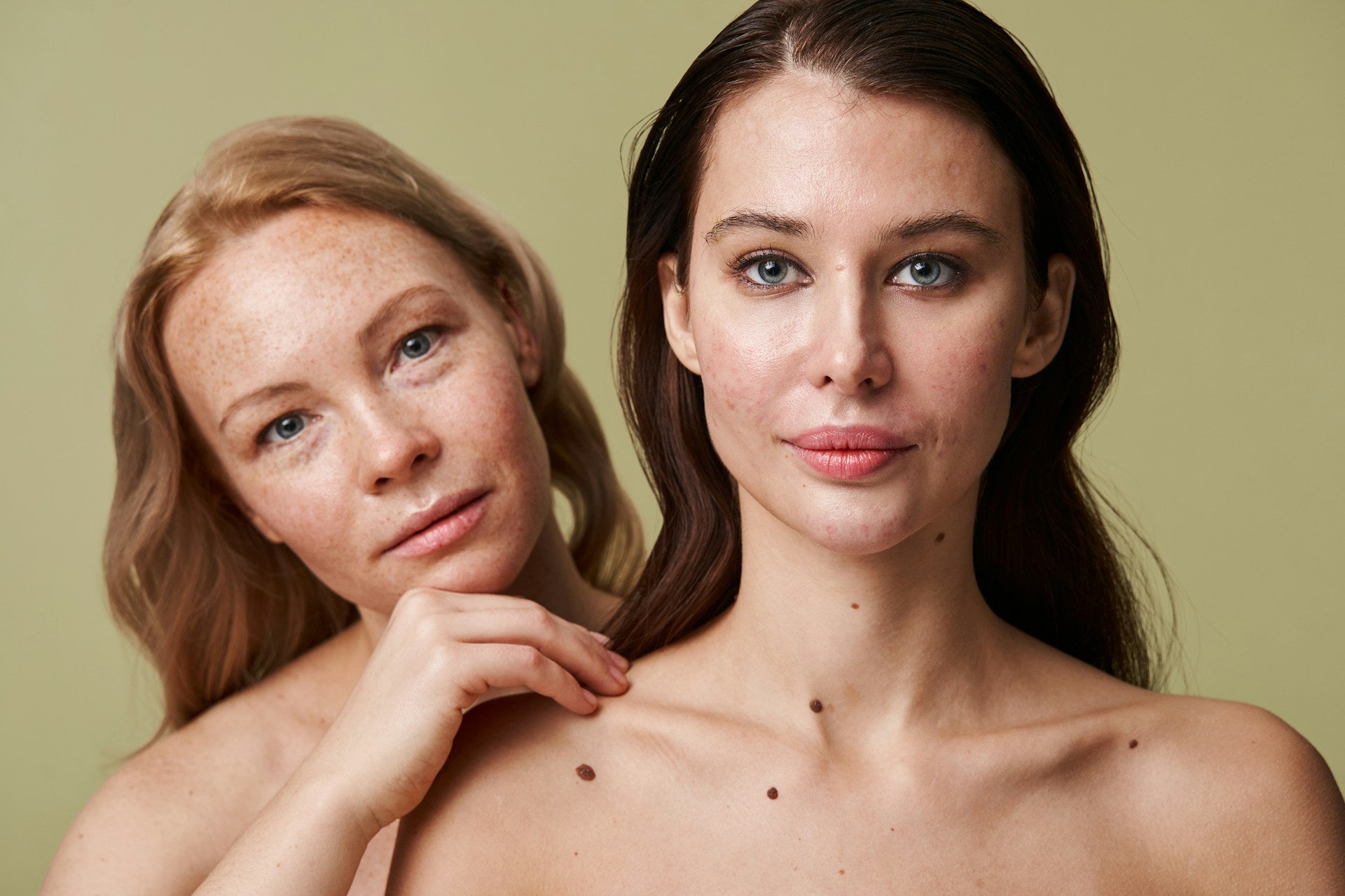 Uneven Skin Tone Hyperpigmentation