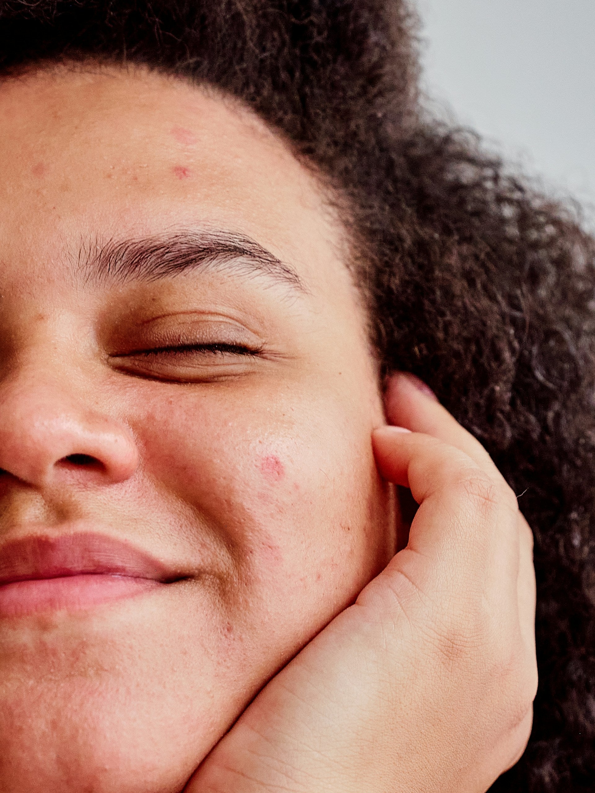 Uneven Skin Tone Hyperpigmentation image 1