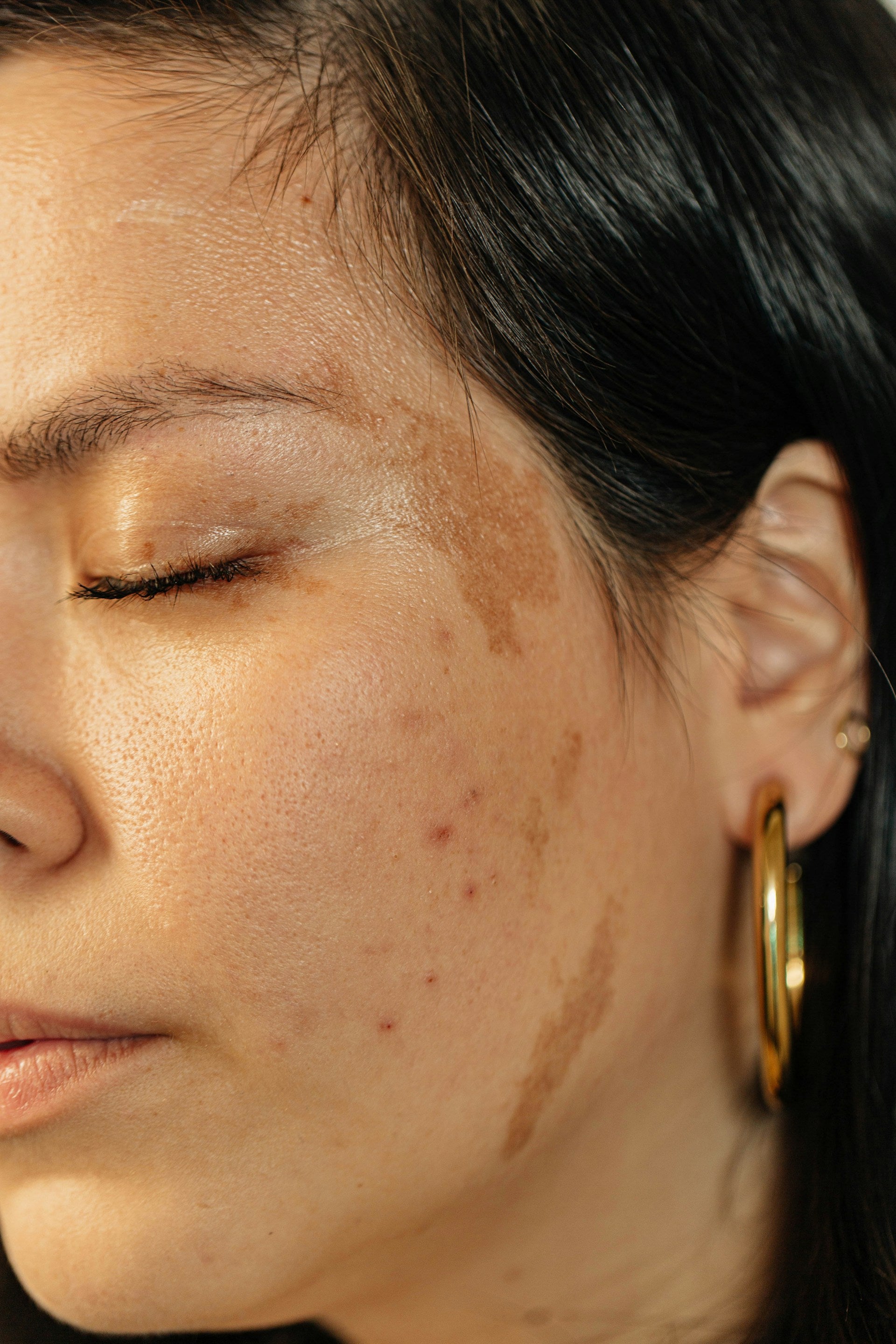 Uneven Skin Tone Hyperpigmentation image 2