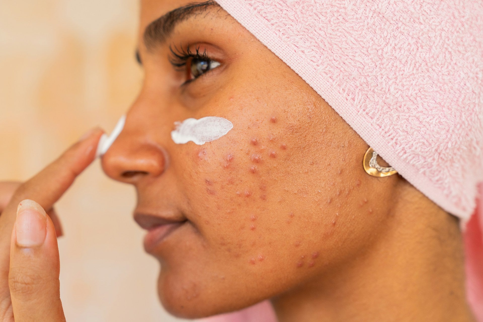 acne and congested skin concern