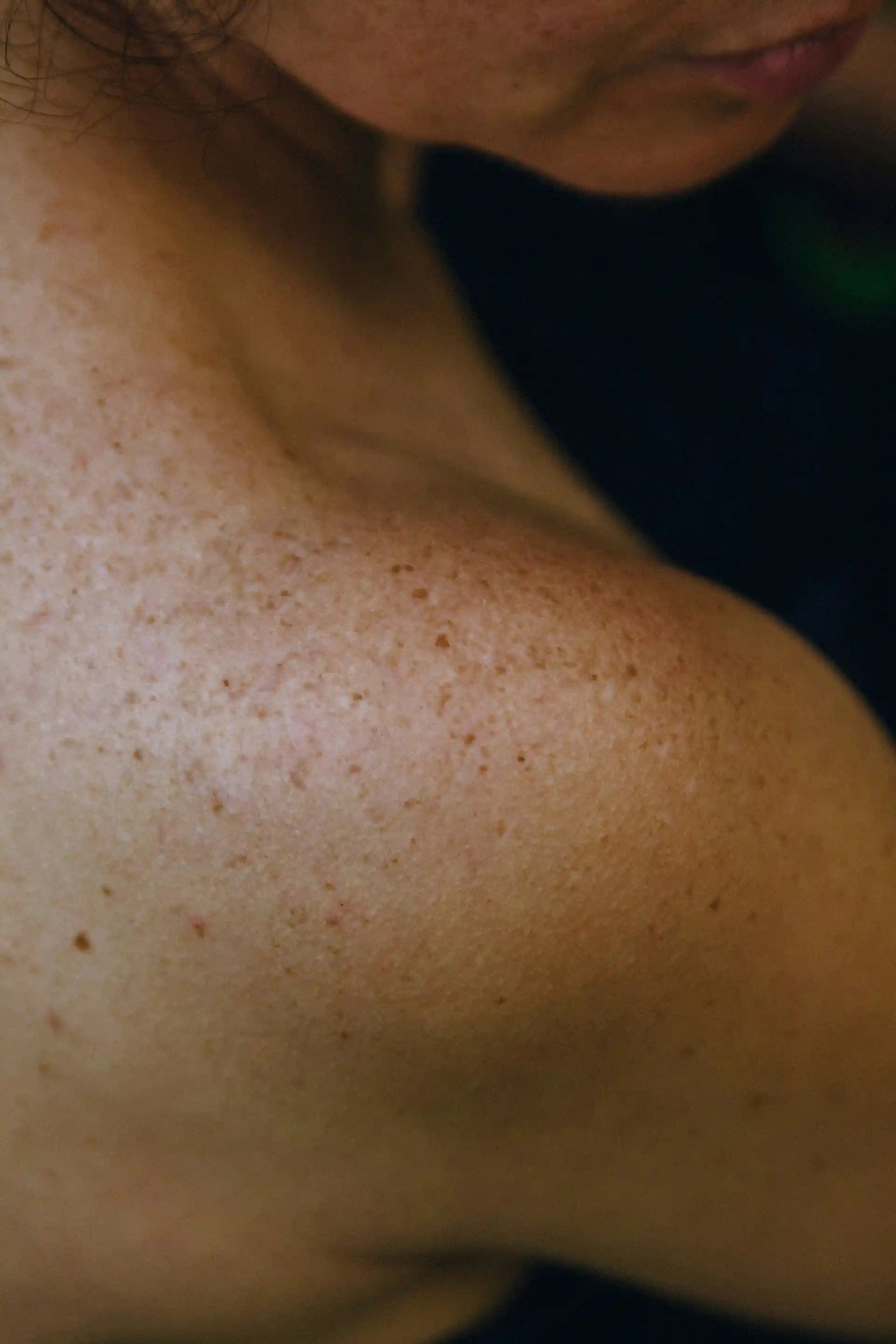 broken thread veins vascular