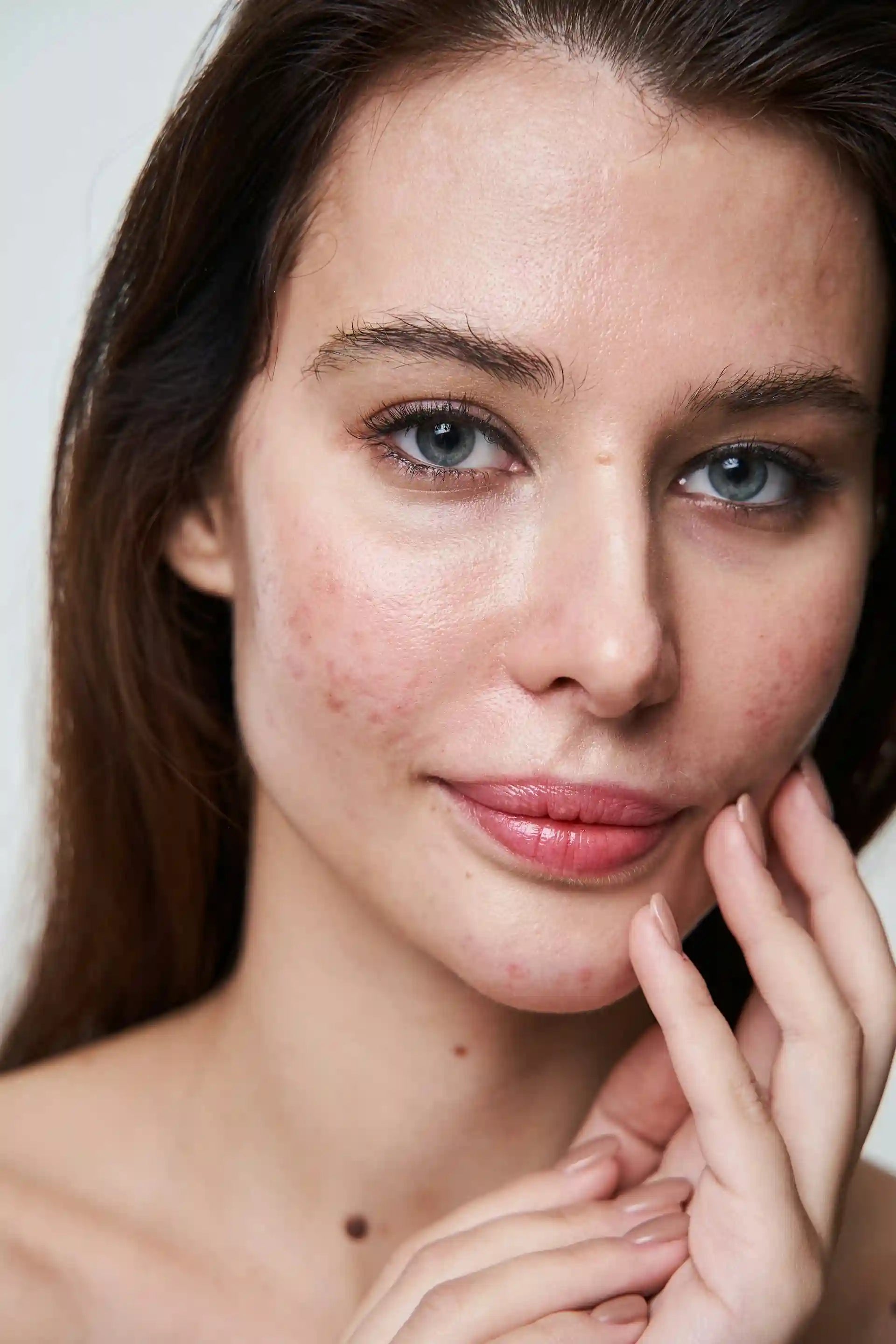 rosacea redness concern hand on face