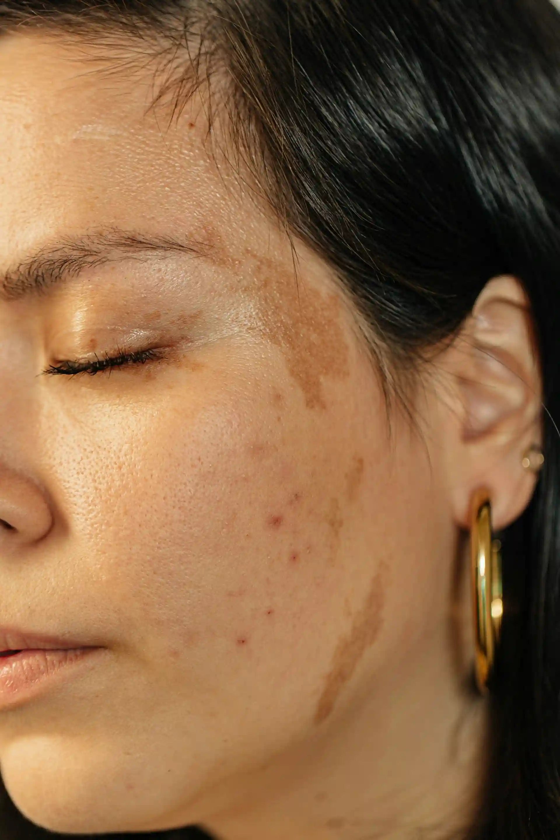 uneven skin tone hyperpigmentation