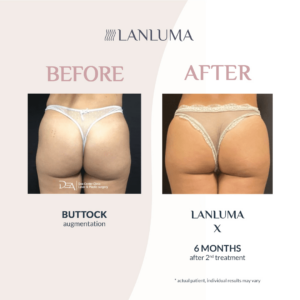 LanLuma Filler Before and After Buttock Lift