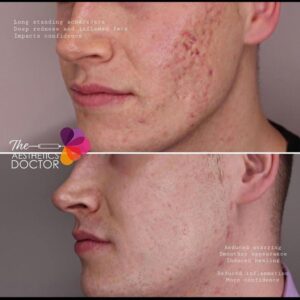 vampire facials acne scars